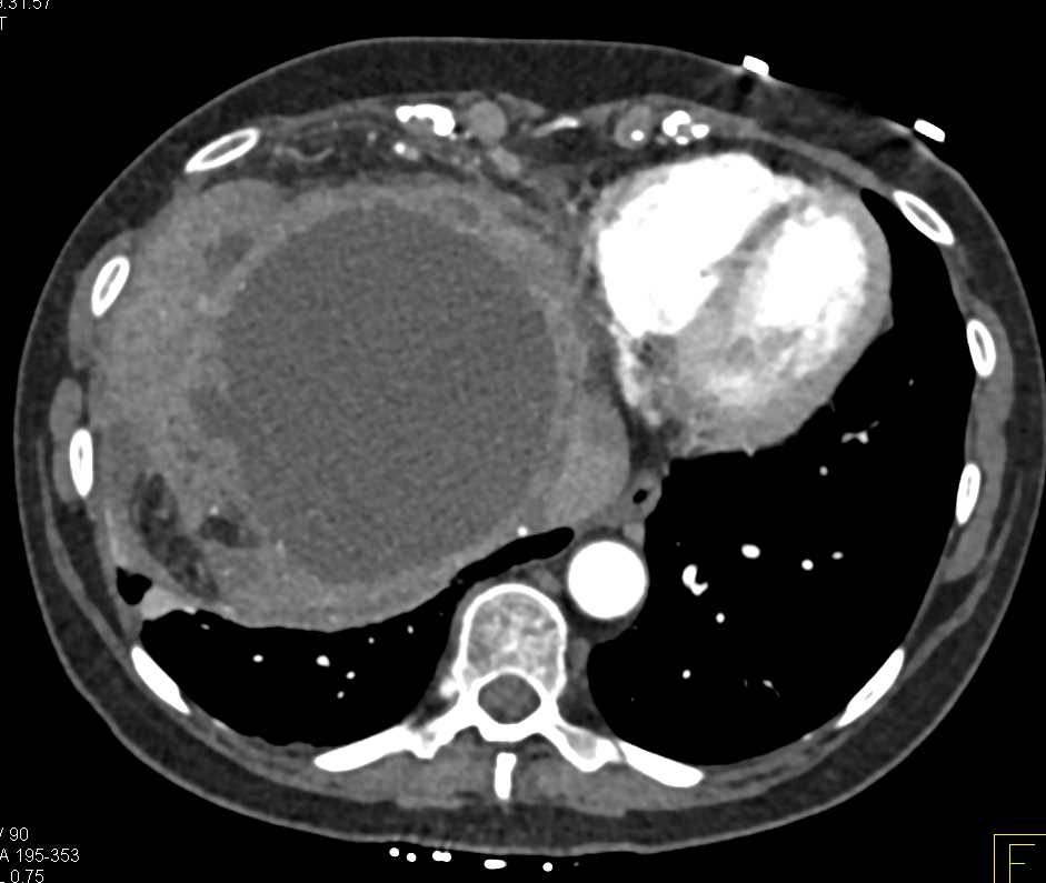 Multiple Hepatic Cysts Including Infected Cyst - CTisus CT Scan