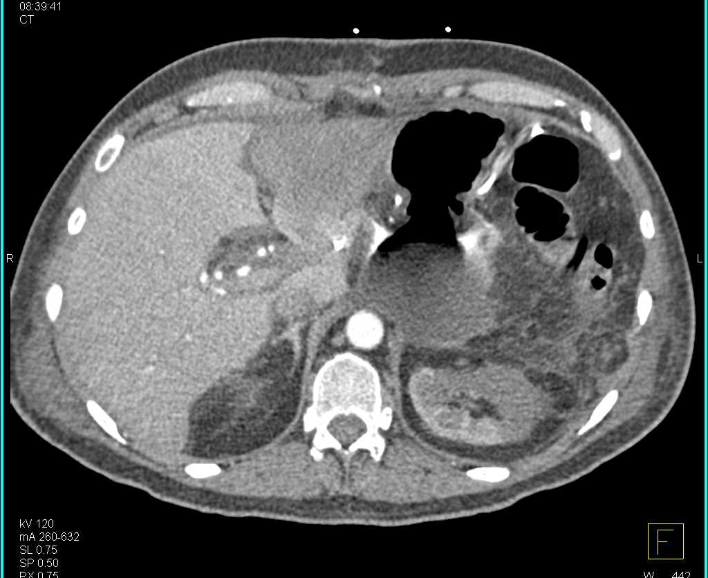 Graft from Iliac Artery to Hepatic Artery Post Liver Transplant - CTisus CT Scan