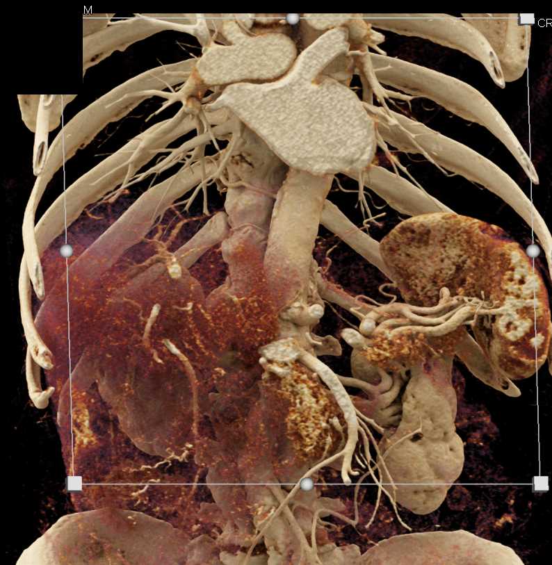 Hepatocellular Carcinoma (Hepatoma) - CTisus CT Scan