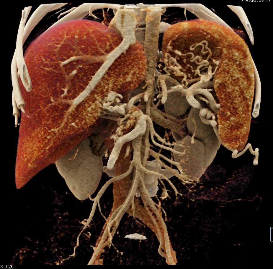 Vascular Collaterals due to Portal Vein Involvement - CTisus CT Scan