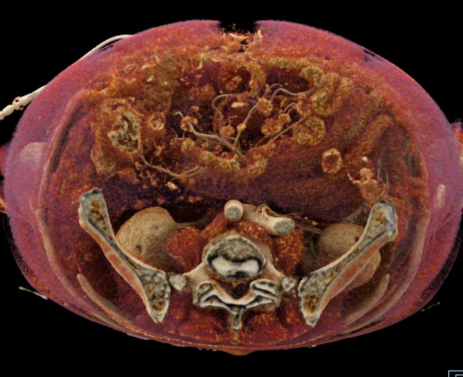 Carcinoma Tail of Pancreas with Carcinomatosis - CTisus CT Scan