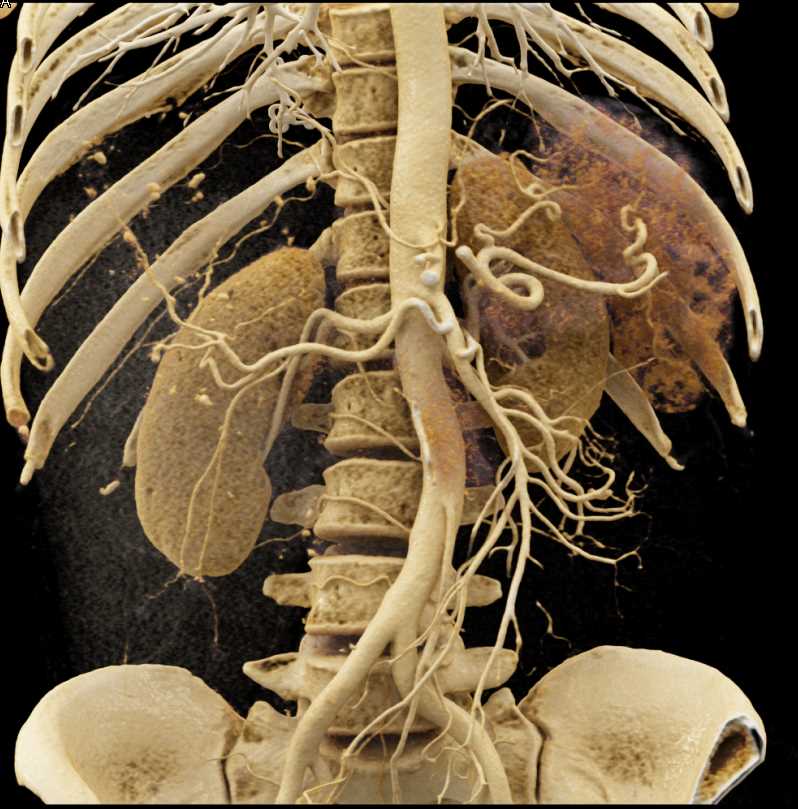 Vascular Hepatic Mass Consistent with a Cavernous Hemangioma with Cinematic Rendering - CTisus CT Scan