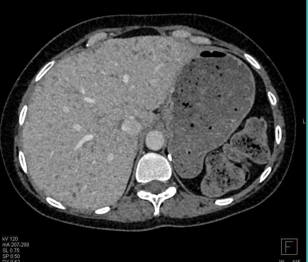 Candidiasis of the Liver - CTisus CT Scan