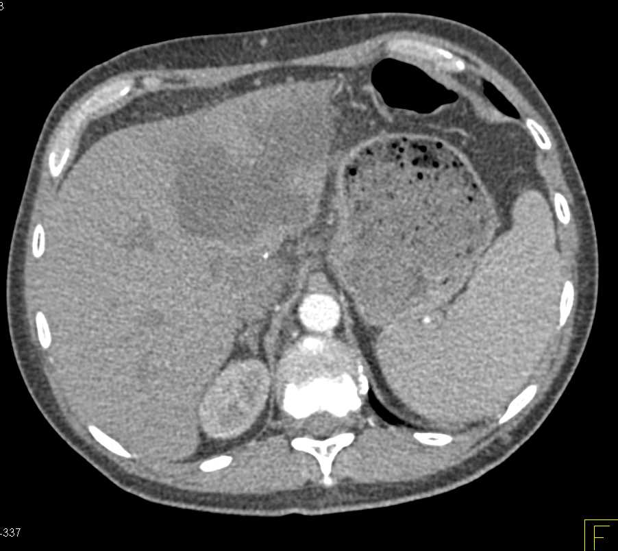Liver Infarction - CTisus CT Scan