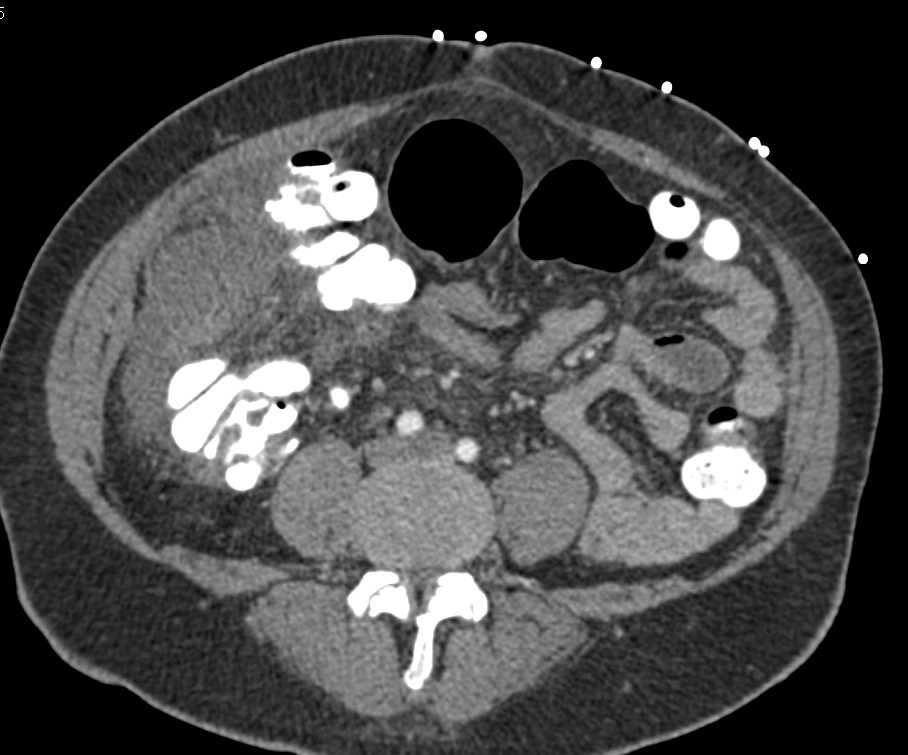 Acute Cholecystitis - CTisus CT Scan