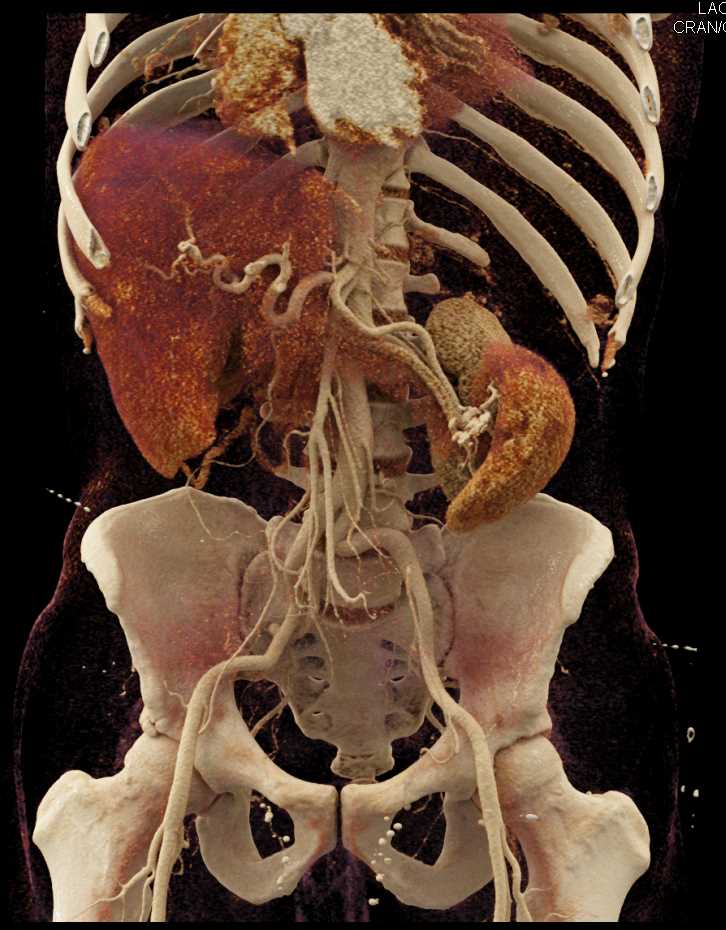 Hepatocellular Carcinoma (Hepatoma) with Neovascularity - CTisus CT Scan