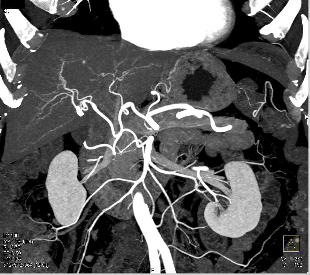 Accessory Right Hepatic Artery off the Superior Mesenteric Artery (SMA) - CTisus CT Scan
