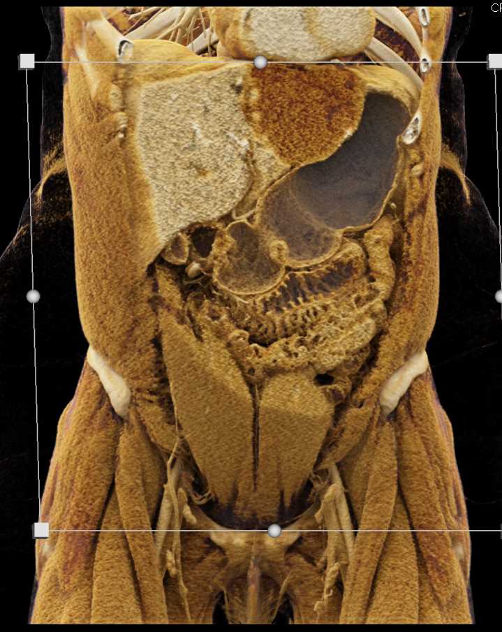Hemangioma with Cinematic Rendering - CTisus CT Scan