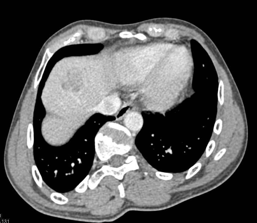 Liver Abscess - CTisus CT Scan