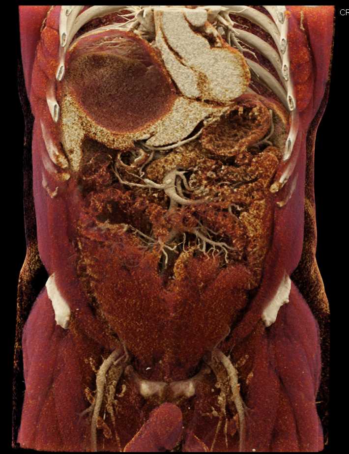Hepatic Abscess - CTisus CT Scan