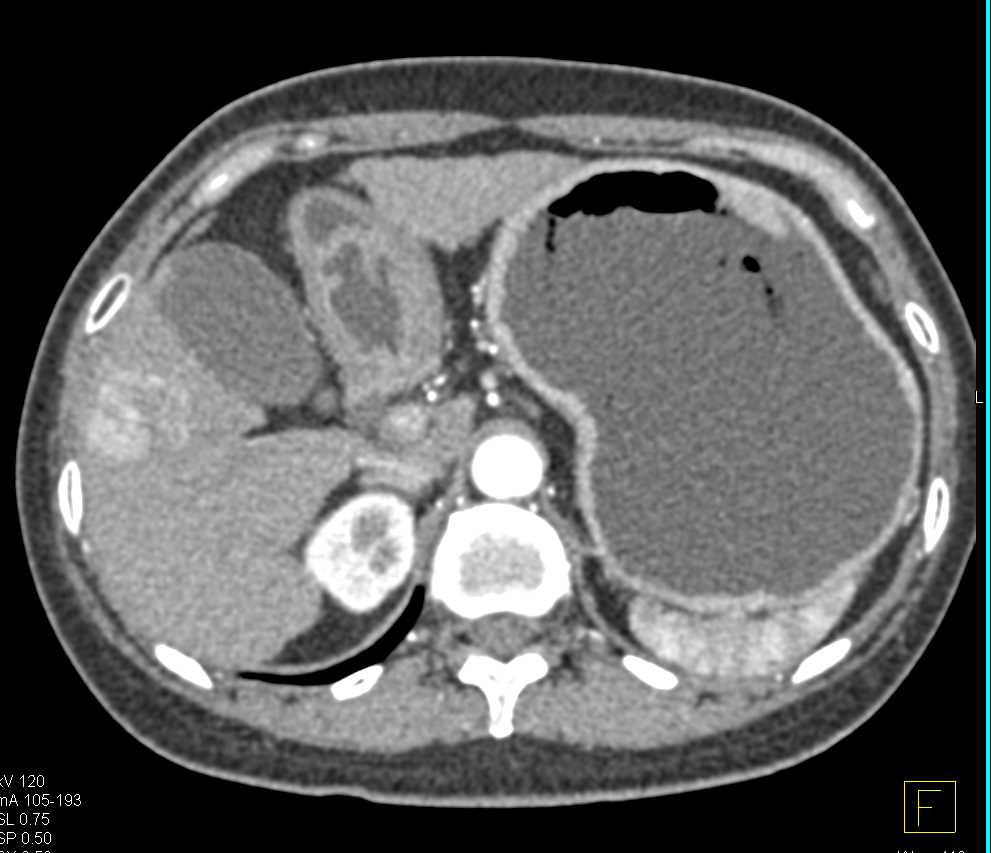 Hepatocellular Carcinoma (Hepatoma) - CTisus CT Scan