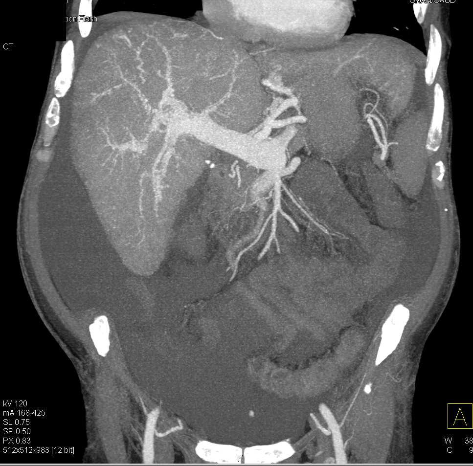 Cirrhosis - CTisus CT Scan