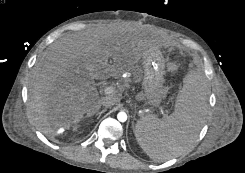 Hepatic Bleed Post Biopsy - CTisus CT Scan