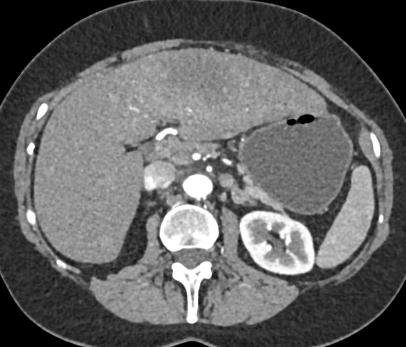 Hepatocellular Carcinoma (Hepatoma) Best Seen on the CT Angiogram - CTisus CT Scan