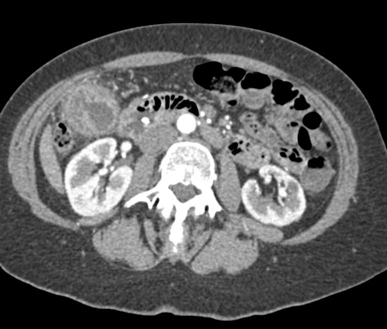 Gallbladder Cancer - CTisus CT Scan