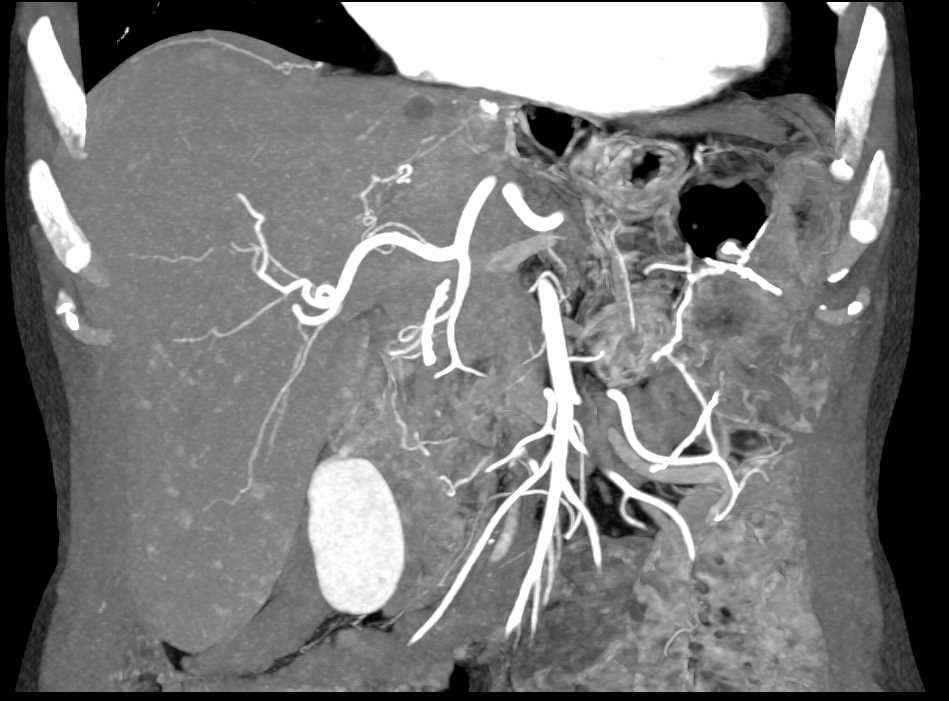 Vascular Lesions in the Liver - CTisus CT Scan