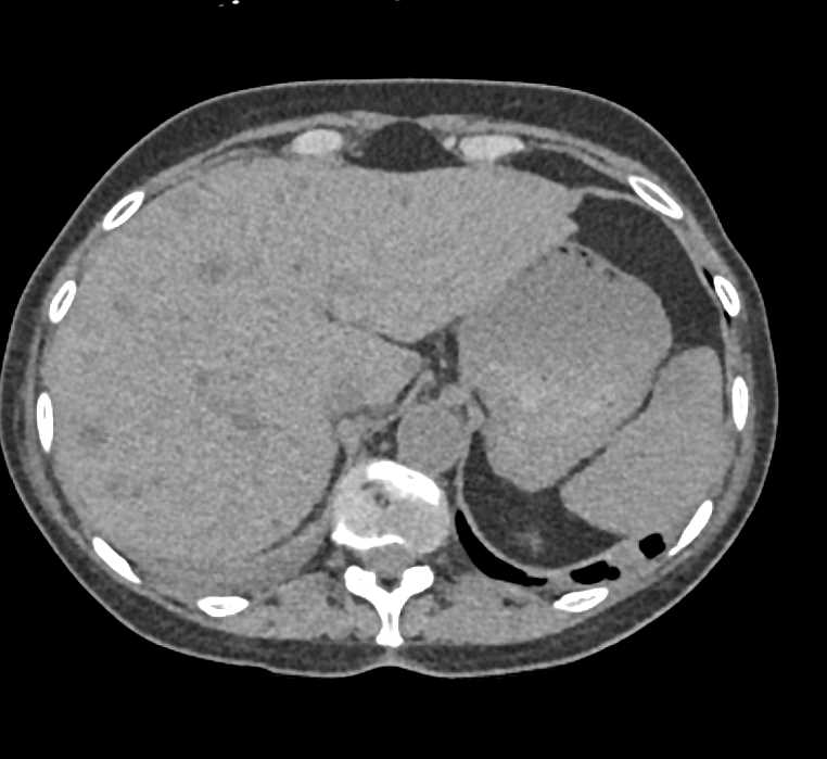 Metastatic Melanoma to Bone and Liver - CTisus CT Scan