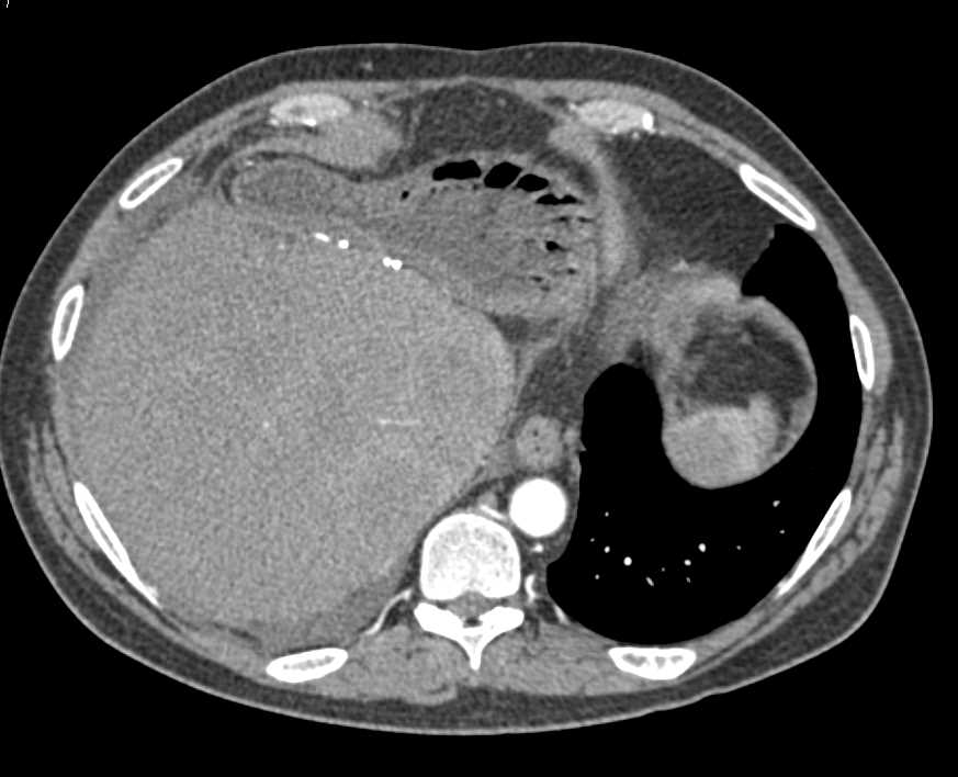Multiple Liver Metastases - CTisus CT Scan