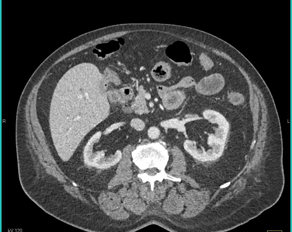 Common Bile Duct Tumor - CTisus CT Scan