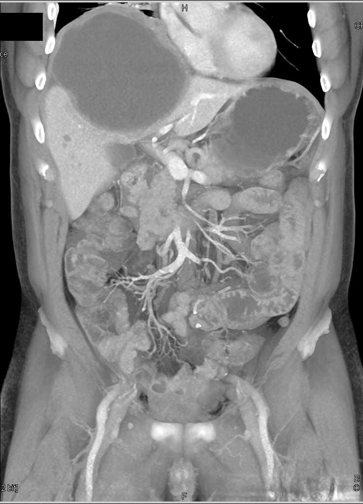 Cystic Cholangiocarcinoma - CTisus CT Scan