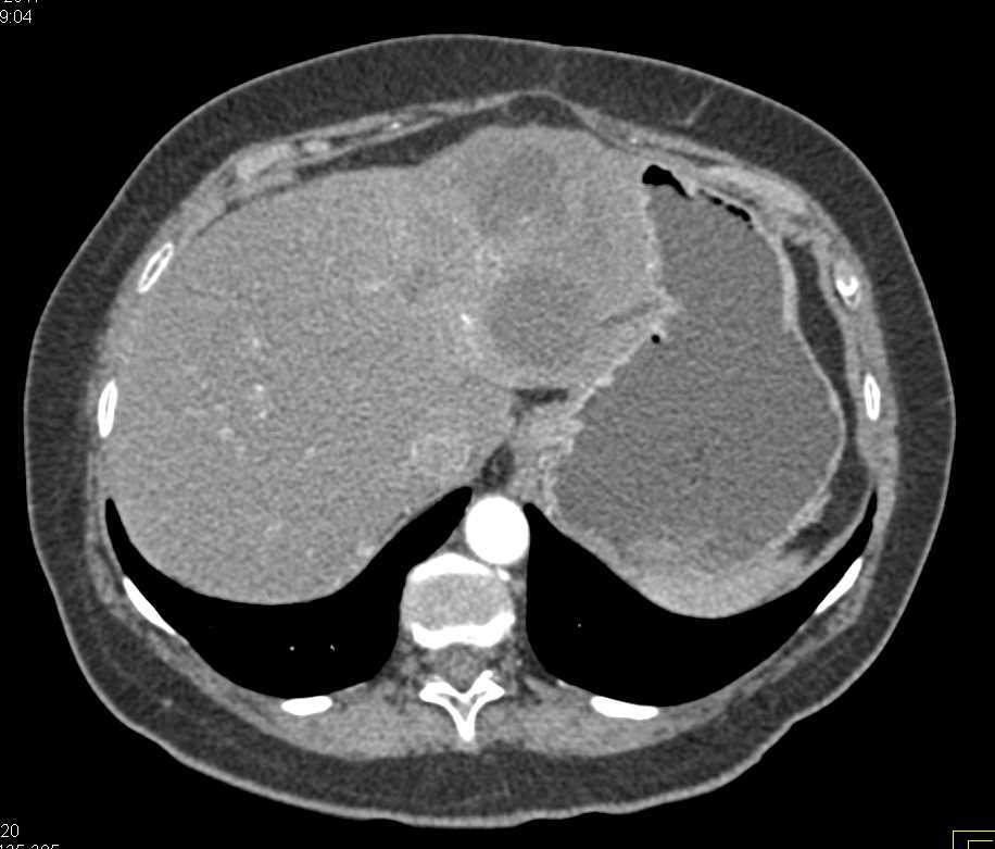 Cholangiocarcinoma Left Lobe of the Liver - CTisus CT Scan