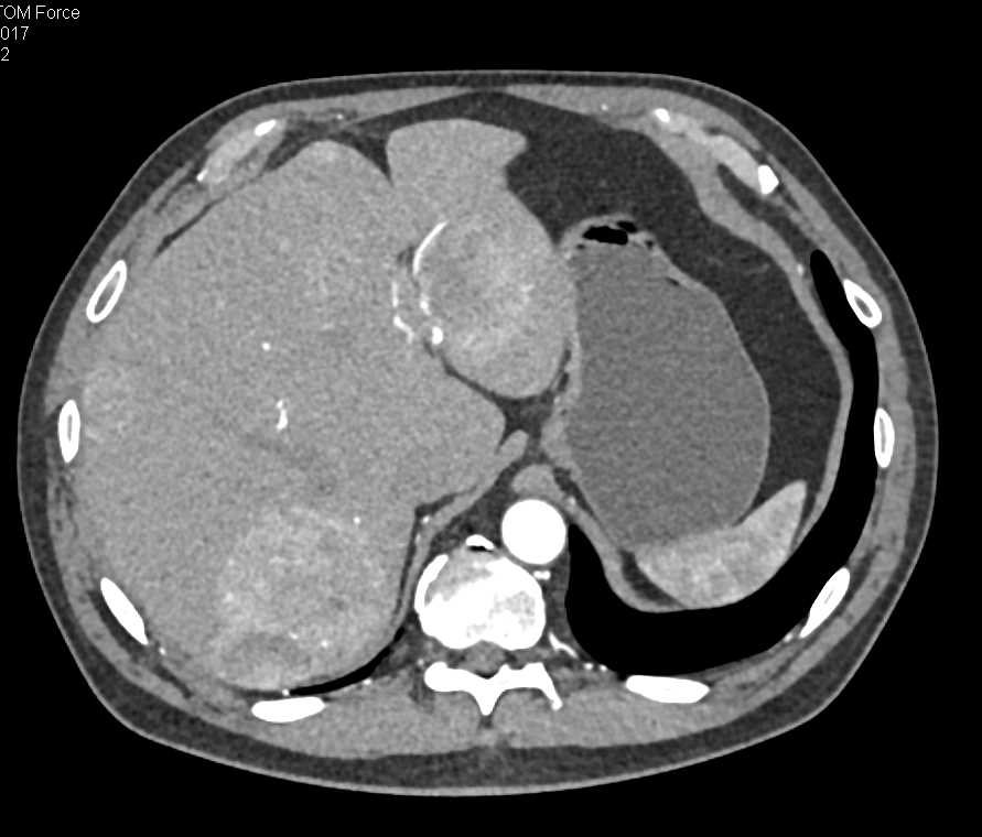 Carcinoid Tumor Root of Mesentery with Liver Metastases - CTisus CT Scan