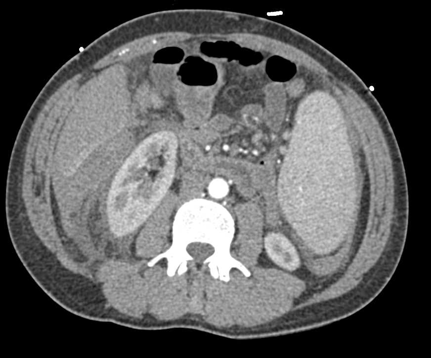 Hemoperitoneum due to Bleed from Right Lobe of the Liver - CTisus CT Scan