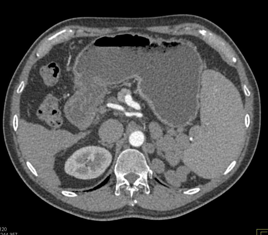Cirrhosis with Splenomegaly and Large Varices - CTisus CT Scan