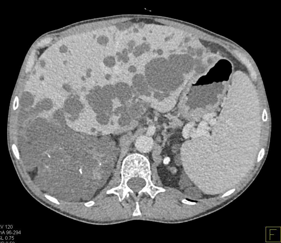 Polycystic Kidney and Liver Disease - CTisus CT Scan