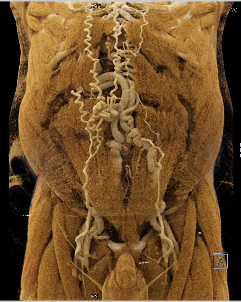 Cirrhosis with Large Varices in Abdominal Wall and Subcutaneous Tissues with Cinematic Rendering - CTisus CT Scan