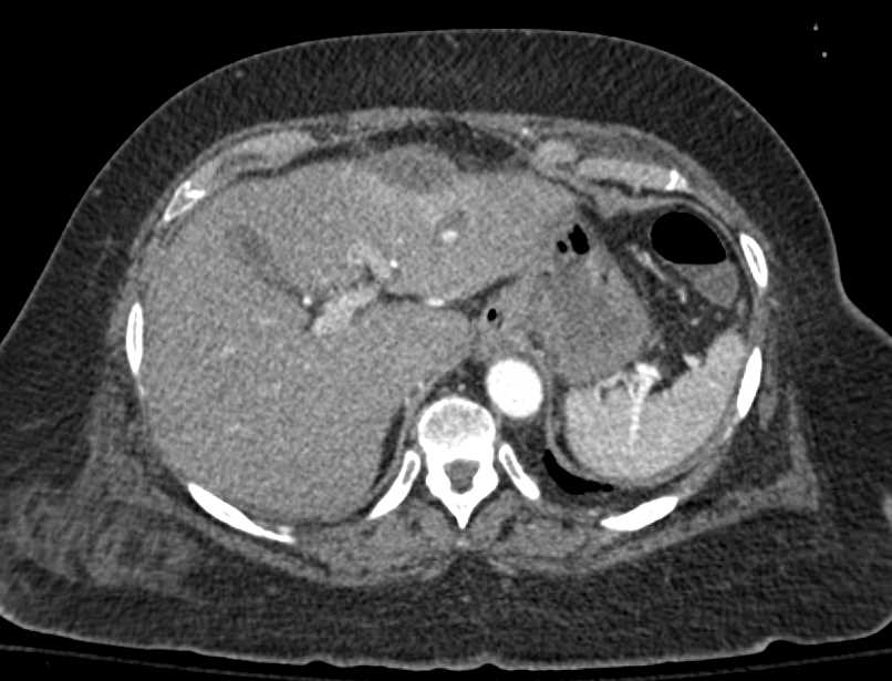 Subcapsular Collection Liver - CTisus CT Scan