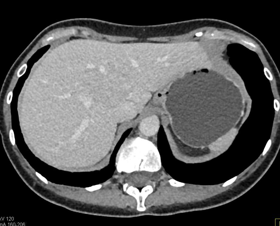 Focal Nodular Hyperplasia (FNH) Liver - CTisus CT Scan
