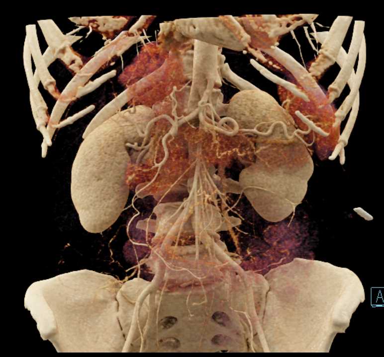 Focal Nodular Hyperplasia (FNH) Liver - CTisus CT Scan
