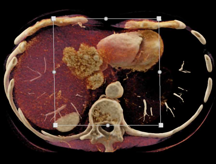 FNH Liver - CTisus CT Scan
