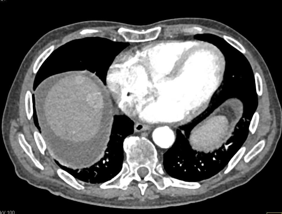 Multifocal Hepatoma - CTisus CT Scan