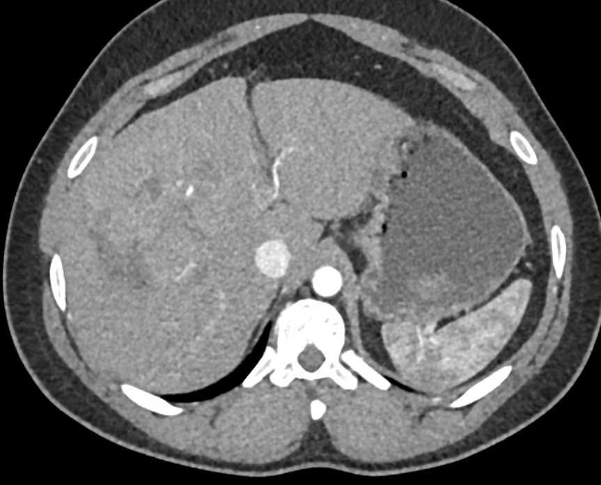 Hepatoma - CTisus CT Scan