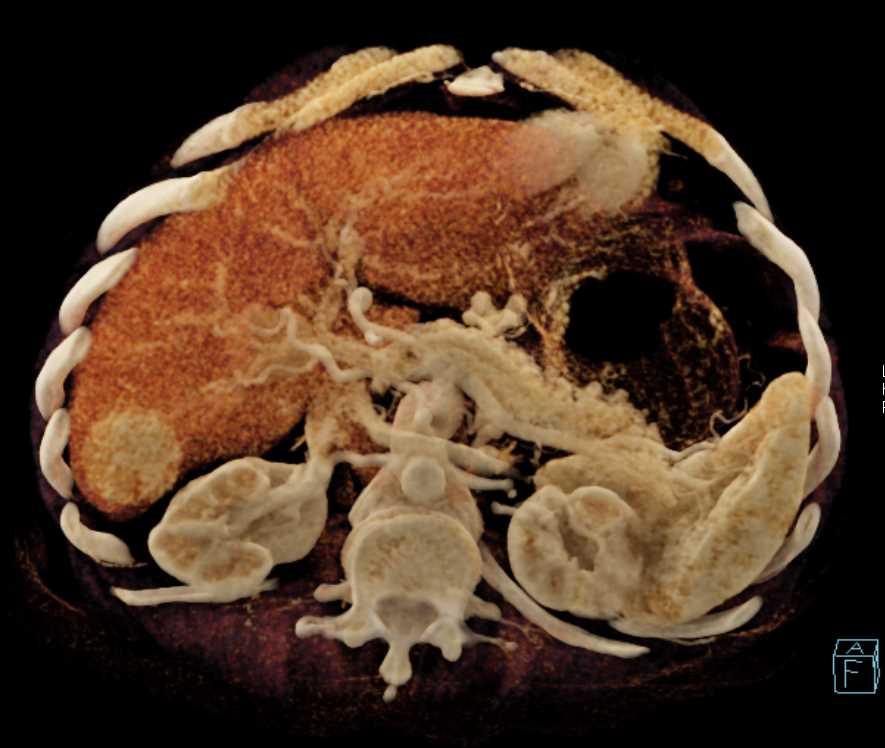 Focal Nodular Hyperplasia (FNH) - CTisus CT Scan