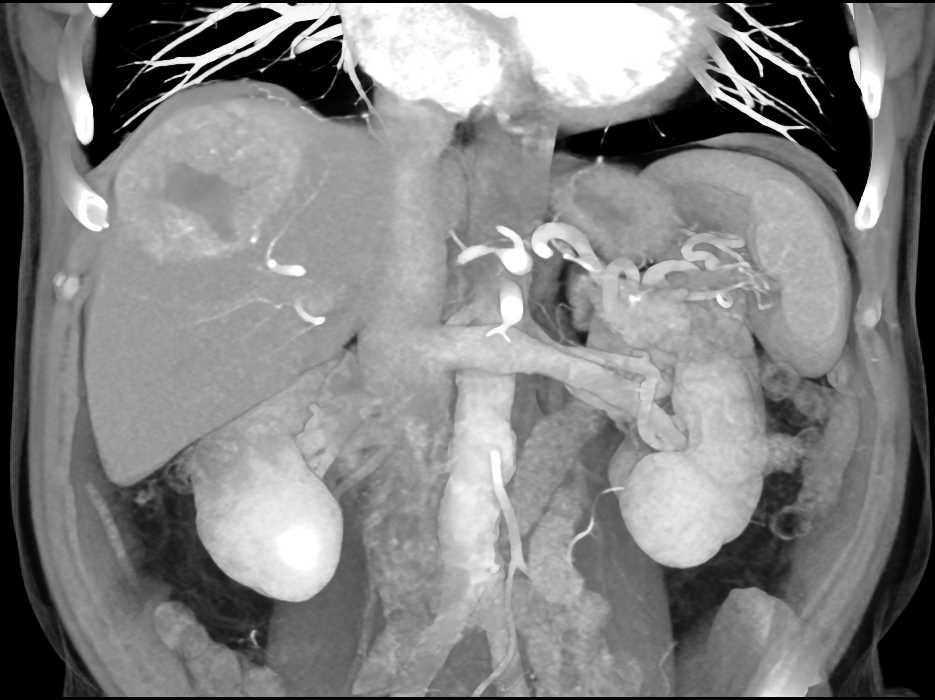 Hepatoma with Neovascularity - CTisus CT Scan