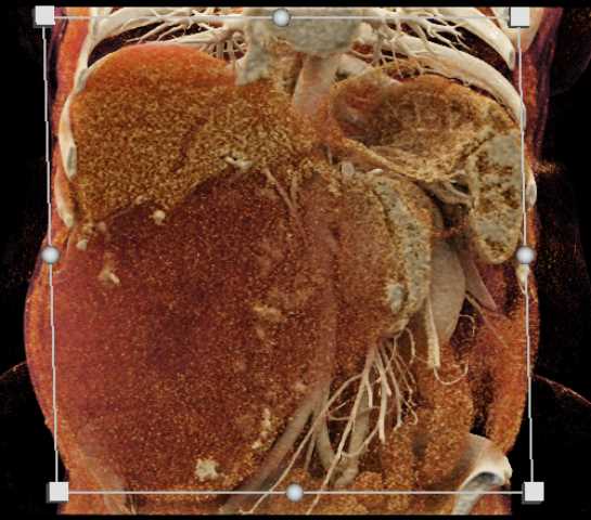 Giant Hepatic Hemangioma - CTisus CT Scan