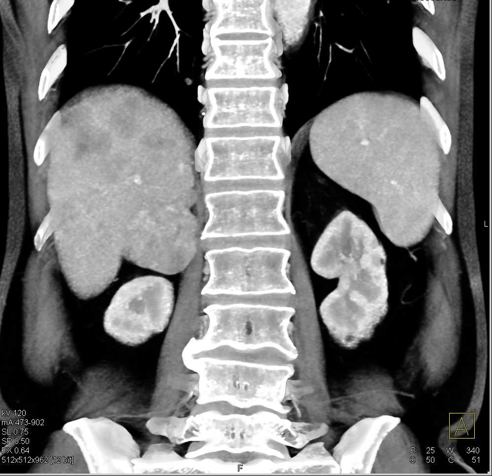 Lymphoma with Adrenal and Liver ad Lung Involvement - CTisus CT Scan