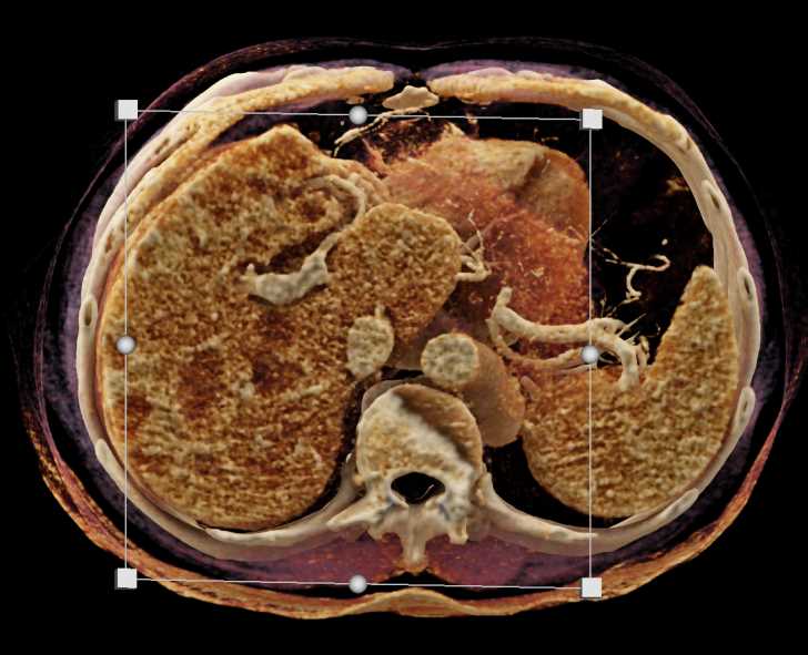 Lymphoma with Adrenal and Liver ad Lung Involvement - CTisus CT Scan