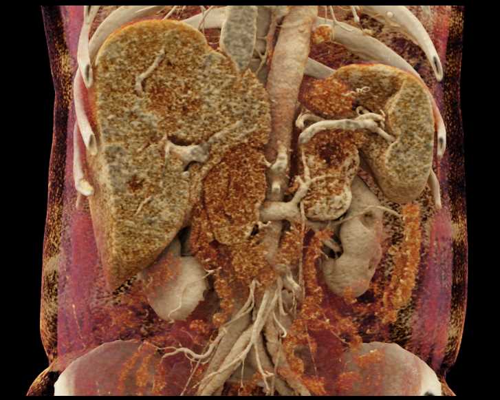 Liver Metastases - CTisus CT Scan