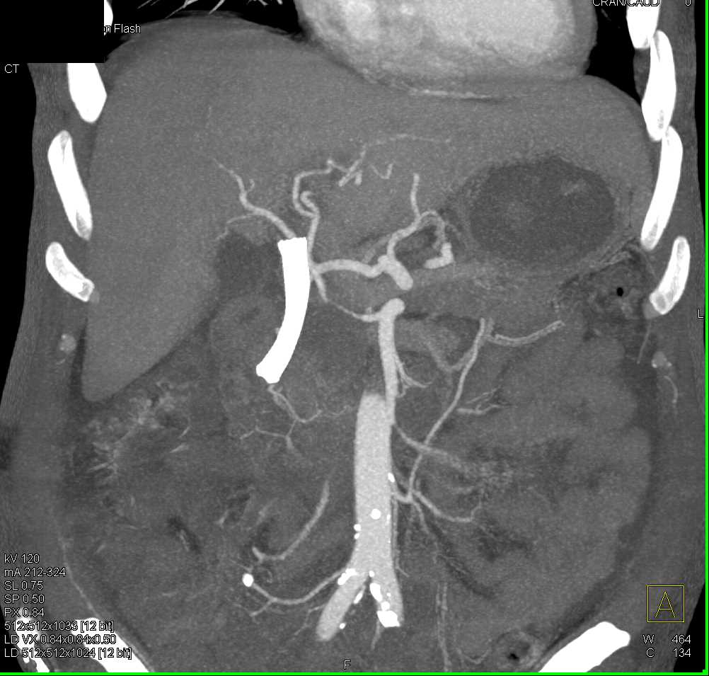 Stent in CBD - CTisus CT Scan