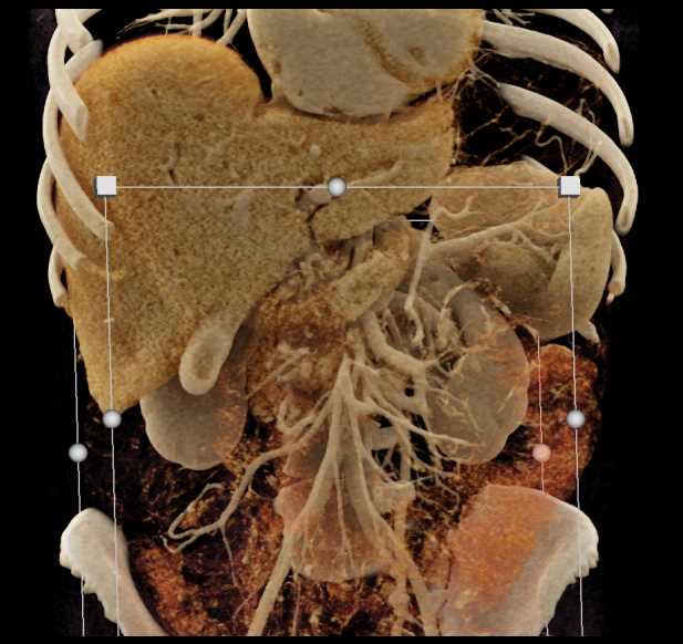 Stent in Common Bile Duct - CTisus CT Scan
