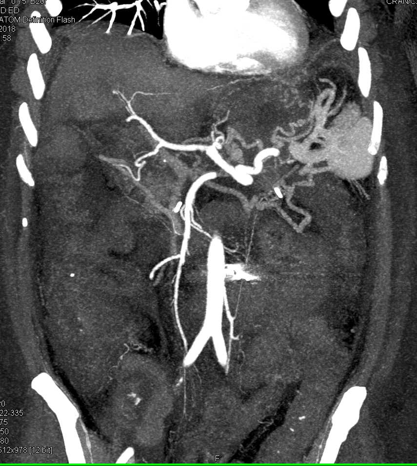 Cirrhosis with Varices - CTisus CT Scan