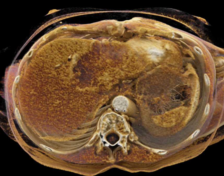 Hepatoma - CTisus CT Scan