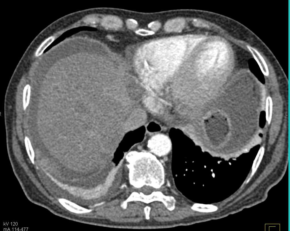 Carcinomatosis with Liver Metastasis - CTisus CT Scan