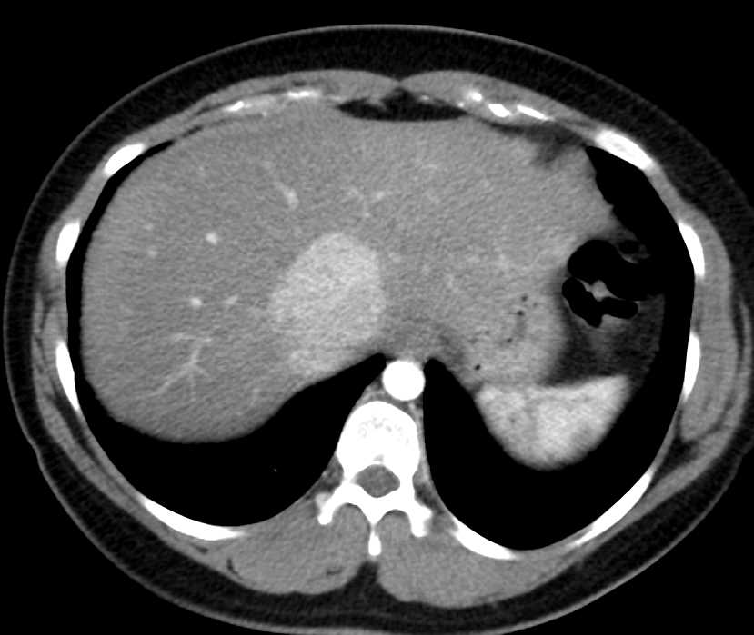 Multiple FNHs - CTisus CT Scan