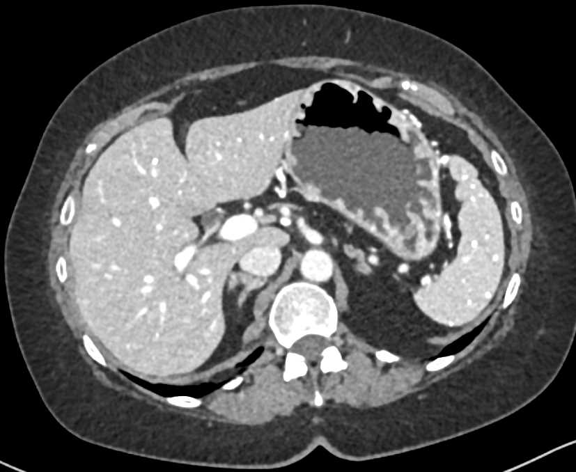 Granulomatous Disease Liver and Spleen - CTisus CT Scan