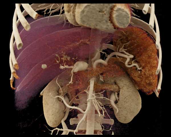 Hepatic Artery Aneurysm - CTisus CT Scan